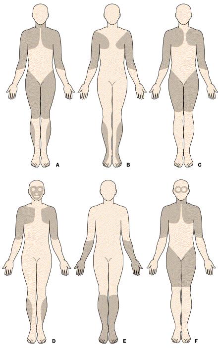 Distribuzione predominante della debolezza muscolare nei diversi tipi di distrofia A