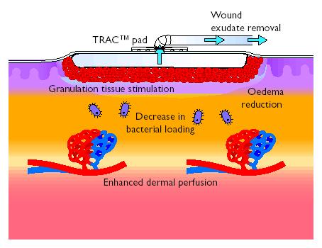 stimolazione/crescita del tessuto di granulazione Rimuove I fluidi interstiziali