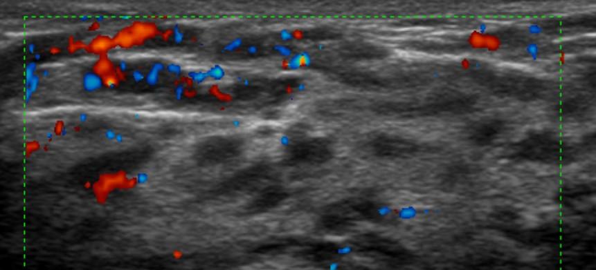 Mammella ds con mastite: tessuto