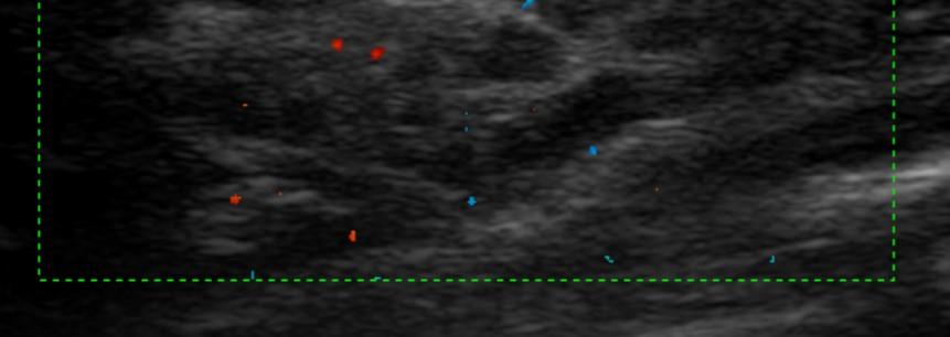 diffusamente ipoecogeno con