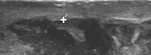 Mammella ds: ascesso mammario Raccolta ipo-anecogena
