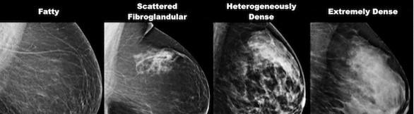 MAMMOGRAFIA DI MAMMELLE CON PATTERN PROGRESSIVAMENTE PIU FIBROGHIANDOLARE.