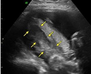 Immagini di distacco di placenta