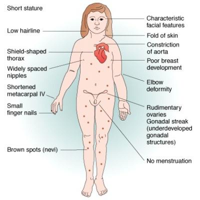 SINDROME DI TURNER La sindrome di Turner (ST) è la più comune delle anomalie cromosomiche nella specie umana, associata a bassa