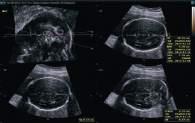 La valutazione delle condizioni del feto diventa più efficiente in quanto la tecnologia 5D LB migliora le precisione delle misurazioni e, contemporaneamente, riduce il tempo necessario per eseguire l