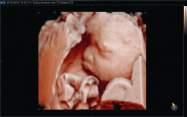 Mano del feto (Realistic Vue ) Realistic Vue con diversi orientamenti della sorgente luminosa HDVI HDVI fornisce immagini di eccellente qualità, con un contrasto migliore, ottima differenziazione dei