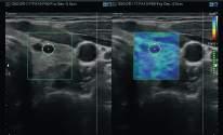 ElastoScan E-Breast (ElastoScan per esami senologici) La