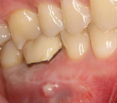 Radiografia 1: granulomi sul molaretto, rischio di infezione del dente incluso,