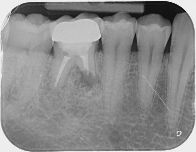 Radiografia 2: apicectomia. Radiografia 3: guarigione. Caso 8.