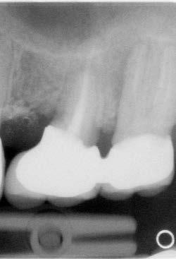 rimozione di tutta la radice, salvando comunque il dente: la rizectomia.