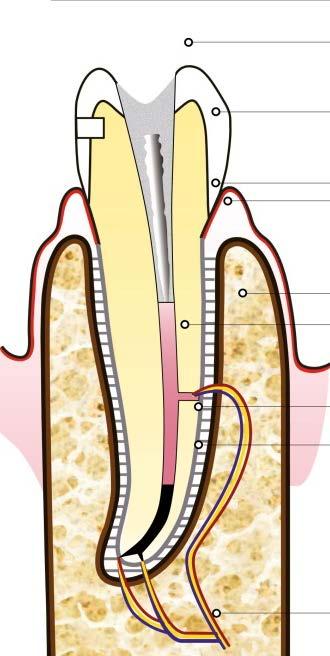 A sinistra: dente necrotico con due granulomi, uno all apice e uno lateralmente, trattato normalmente (per via ortograda, cioè facendo una apertura nella corona del dente).