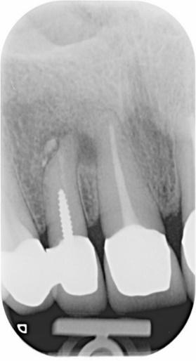 Dente incisivo laterale superiore.