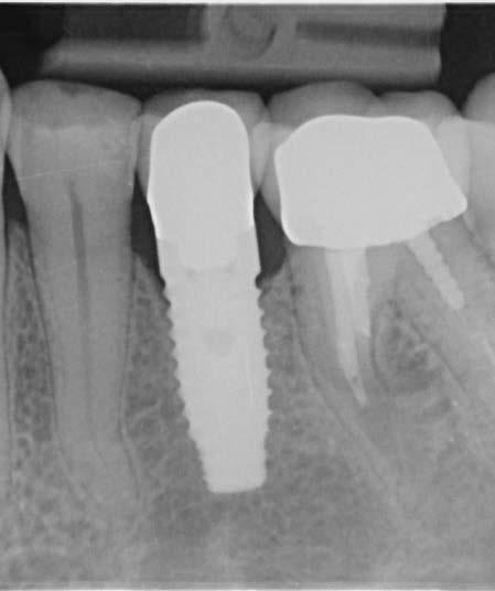 Caso 5. Dente molare superiore destro 8