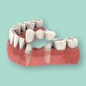 Protesi mobile totale: è la soluzione per chi è privo di tutti i denti su una o entrambe le arcate dentarie; essa è costituita da denti artificiali di resina o ceramica, inseriti su una base di