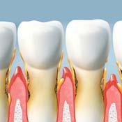 Compromissioni parodontali gravi, possono richiedere anche l intervento della chirurgia.