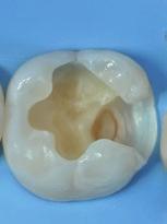 medio-alto valore A2; costruzione del corpo dentinale