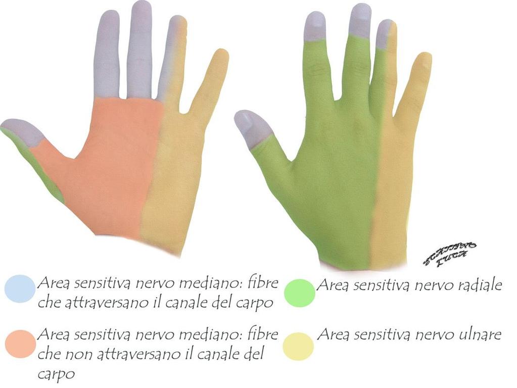 Parestesie nelle prime 4 dita della man0 S. del Pronatore Rotondo Sintomatologia Parestesie nel triangolo palmare (area sensitiva innervata da fibre sensitive del n.