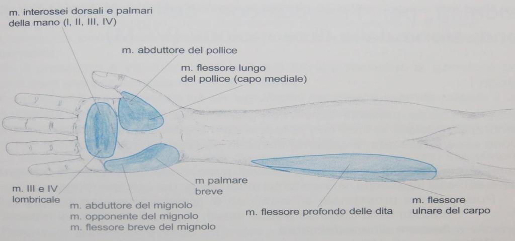 Sindrome Compressiva del Nervo Ulnare al Polso (Sindrome di Guyon) Sintomatologia