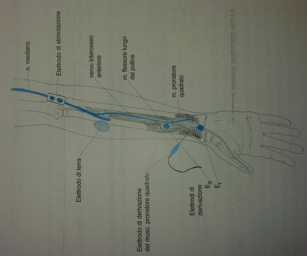S. del nervo interosseo anteriore (NIA) Esami elettrofisiologici A.