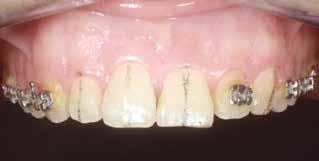 4 Incontro 13-14 giugno 2014 SW in dentizione mista Old patients Periodontal tooth migrations (PTM) Controllo della posizione dei brackets Rebonding critico Finitura Straight Wire in dentizione mista