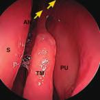 10 La dissezione anatomica endoscopica de distretto rino-sinusae 3.