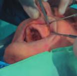 La dissezione anatomica endoscopica de distretto rino-sinusae 13 3.