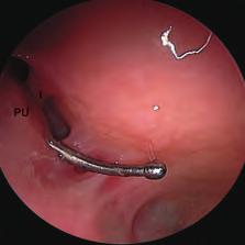 16, 17): a morfoogia de seno masceare con i suoi recessi aveoari mediae e aterae, i recessi orbitari mediae e aterae, ostio naturae in posizione supero-mediae, eventuai osti accessori, i