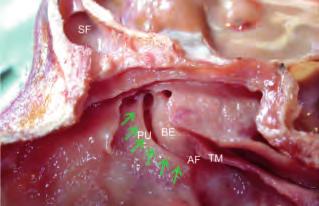 La dissezione anatomica endoscopica de distretto rino-sinusae 17