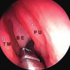 18 La dissezione anatomica endoscopica de distretto rino-sinusae 6.1.2 Dissezione Fig.