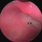 La dissezione anatomica endoscopica de distretto rino-sinusae 19 Dopo aver eseguito uncinectomia parziae/totae, nea maggior parte dei casi, è visibie ostio naturae de seno masceare.