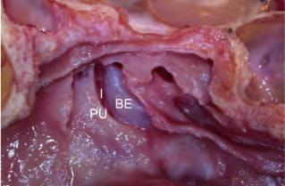 La dissezione anatomica endoscopica de distretto rino-sinusae 21 6.3 III tempo: apertura etmoide anteriore (II porta etmoidae) 6.3.1 Anatomia La bua etmoidae è, abituamente, a ceetta de etmoide anteriore di mag giore dimensione (fig.