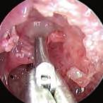 24 La dissezione anatomica endoscopica de distretto rino-sinusae 6.4.2 Dissezione L approccio a recesso frontae appare i tempo chirurgico più difficie e deicato di tutta a dissezione endoscopica etmoidae.