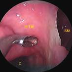 26 La dissezione anatomica endoscopica de distretto rino-sinusae 6.5 V tempo: abbattimento porzione frontae turbinato medio (III porta etmoidae) 6.5.1 Anatomia Fig.