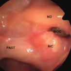 La dissezione anatomica endoscopica de distretto rino-sinusae 29 turcica, che forma una protuberanza sua inea mediana.