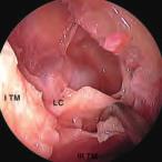 30 La dissezione anatomica endoscopica de distretto rino-sinusae Fig. 64 Fossa nasae sinistra.