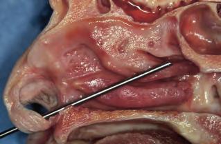 La dissezione anatomica endoscopica de distretto rino-sinusae 7 2.
