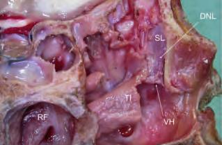 2); ispezione deo sbocco de dotto naso-acrimae, che si apre a iveo de meato inferiore (fig. 3). Fig. 2 Immagine de terzo anteriore dea fossa nasae sinistra.