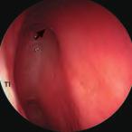 La dissezione anatomica endoscopica de distretto rino-sinusae 9 Tavota orifizio appare ricoperto da una membrana mucosa, a vavoa di