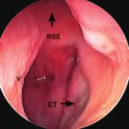 endoscopio su proprio asse, a vautazione de ostio tubarico e dea fossetta di Rosenmüer controaterai (figg. 7, 8). Fig.