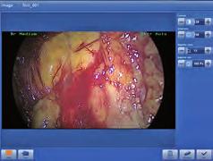 La dissezione anatomica endoscopica de distretto rino-sinusae 95 KARL STORZ AIDA compact NEO advanced La documentazione d ecceenza continua!