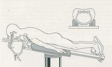 Se la lordosi fisiologica è conservata (cioè la curva del collo è normale), è indicata una laminoplastica mediante un accesso posteriore LAMINOPLASTICA: Mediante un accesso posteriore al rachide