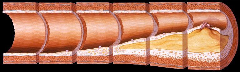 ATHEROSCLEROSIS TIMELINE Foam Cells Fatty Streak Intermediate Lesion Atheroma Fibrous Plaque Complicated Lesion/Rupture