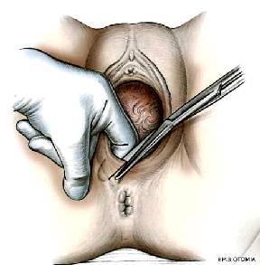 LʼEPISIOTOMIA Anche detta perineotomia è un taglio praticato ad arte con le forbici appropriate (Braun-Stadler o forbice retta a margini smussi da Mayo) nello spessore del perineo ed ha lo scopo di