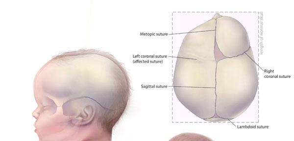 Diagnosi Prenatale Craniosinostosi sindrome di Muenke