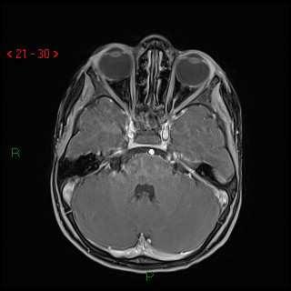 RMN encefalo Diagnosi