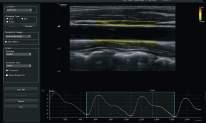 Arterial Analysis TM La tecnologia Arterial AnalysisTM individua le modificazioni dei vasi,