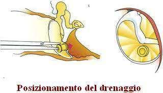 Nell'adulto andranno parimenti risolte tutte le eventuali patologie nasali (deviazioni del setto, ipertrofia dei turbinati, polipi ecc ) o rinofaringee (residui adenoidei, fibromi, neoplasie ecc.