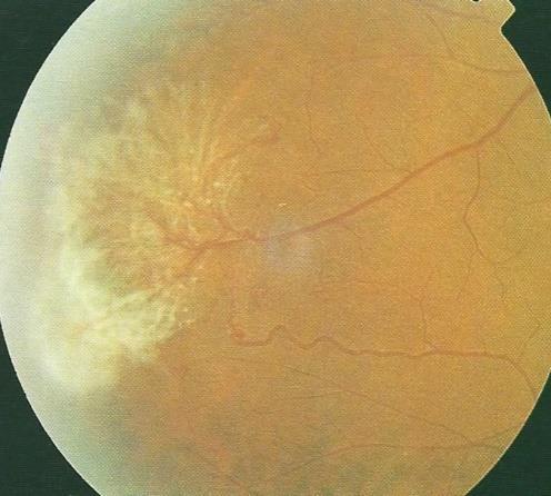 retiniche