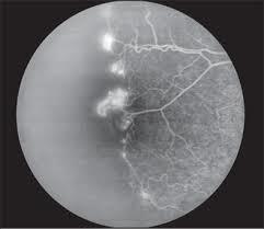 Incidence and natural history of proliferative sickle cell retinopathy: observations from a cohort study. Downes SM, Hambleton IR, Chuang EL, Lois N, Serjeant GR, Bird AC.