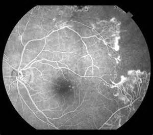 Risultati Indipendentemente dalla terapia con HU I pazienti con HbF <15% hanno una probabilità 7.1 volte maggiore di sviluppare retinopatia.